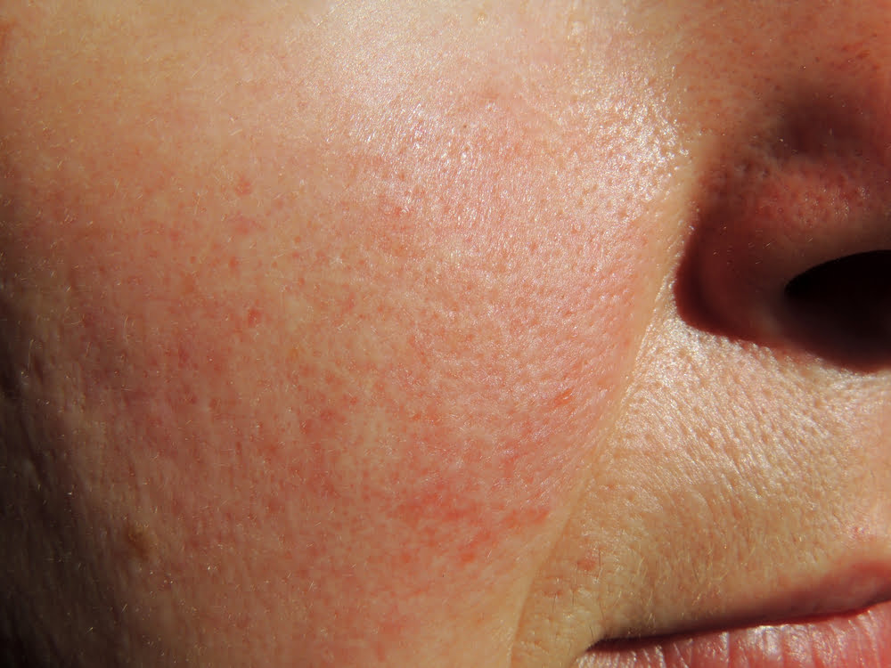 Rosacea Clinic In Preston Rosacea Treatment Preston