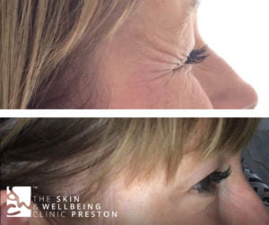 crows feet botox injection in Preston