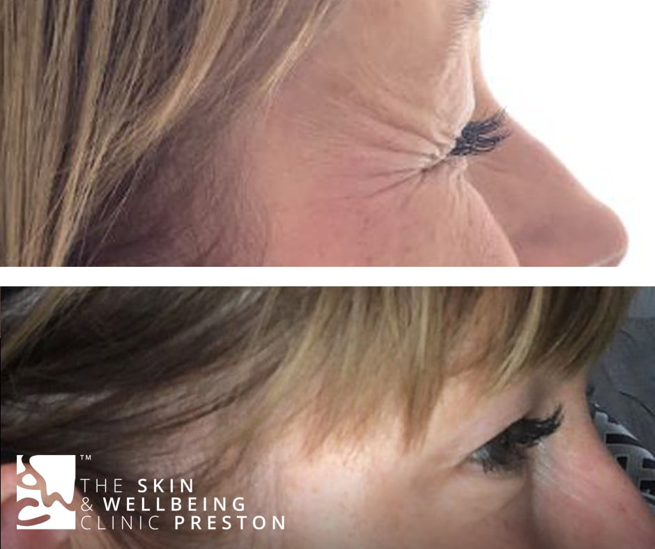 crows feet botox injection in Preston