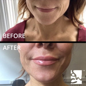 LIP FILLERS