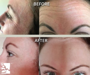 crows feet and brow anti wrinkle injections