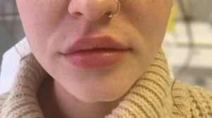 lip fillers before and after - after portrait