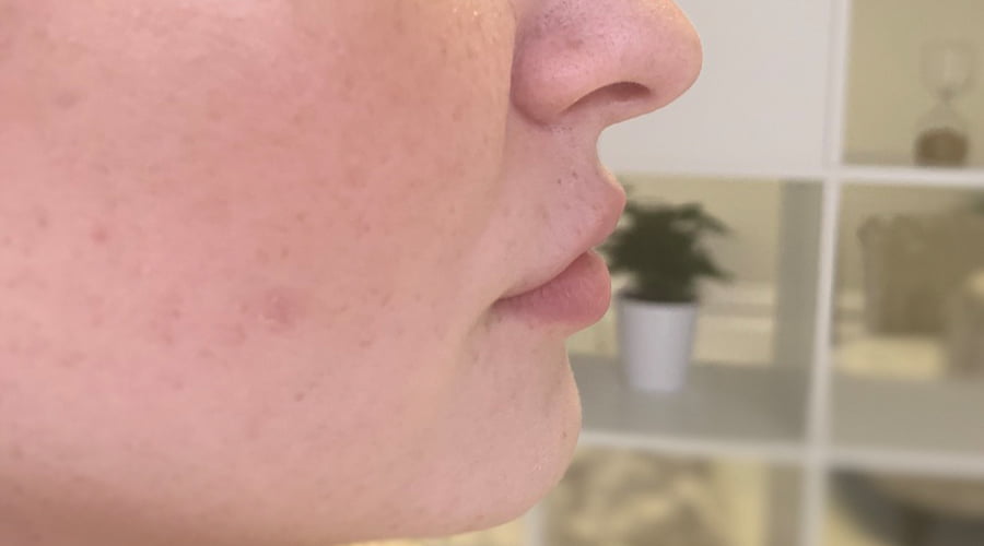 lip fillers before and after - before profile