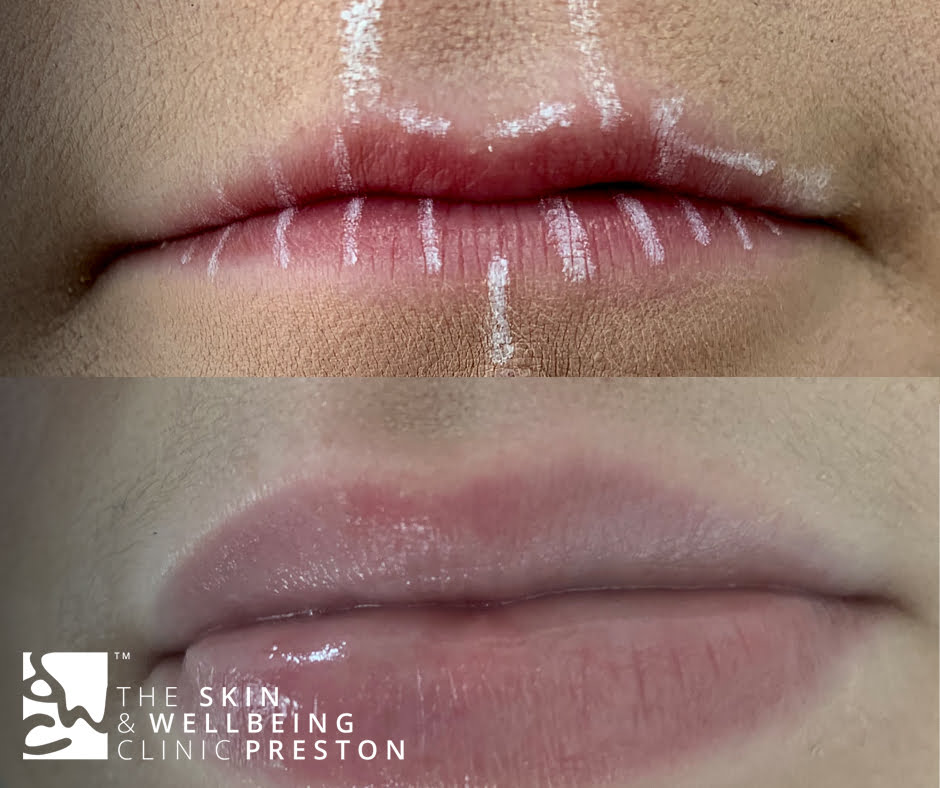 before and after lip enhancement