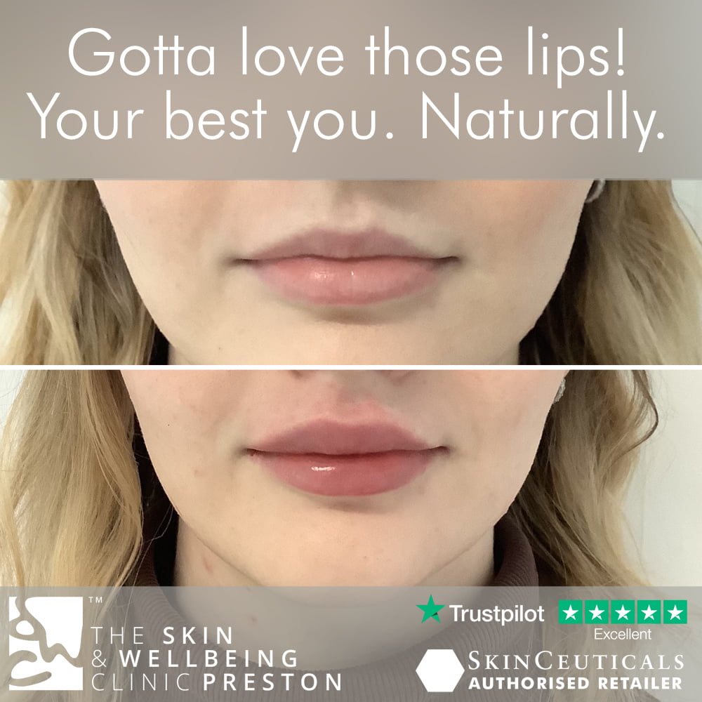 lip fillers in Preston Clinic